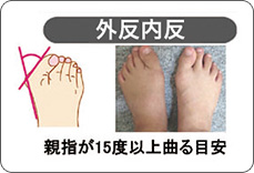 外反内反