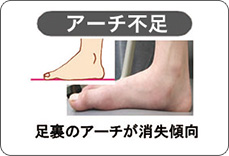 アーチ不足