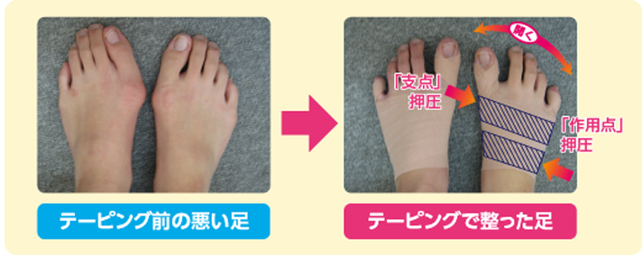 足のテーピング
