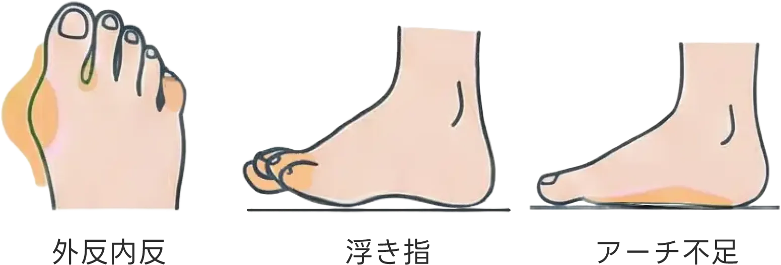 外反内反・浮き指・アート不足